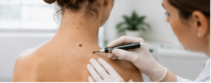 Mole Removal